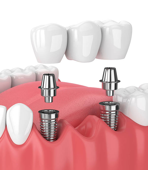 Dental Bridges Spring