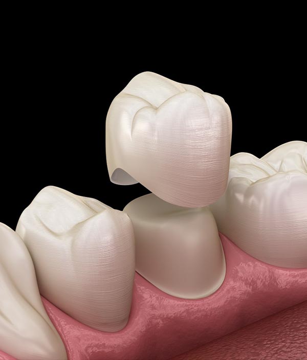 Dental Crowns in Spring