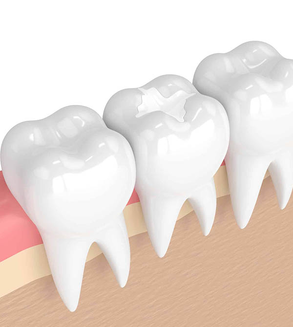Dental Sealants in Spring