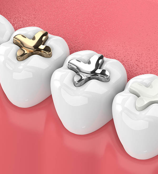 Quality Dental Fillings Spring
