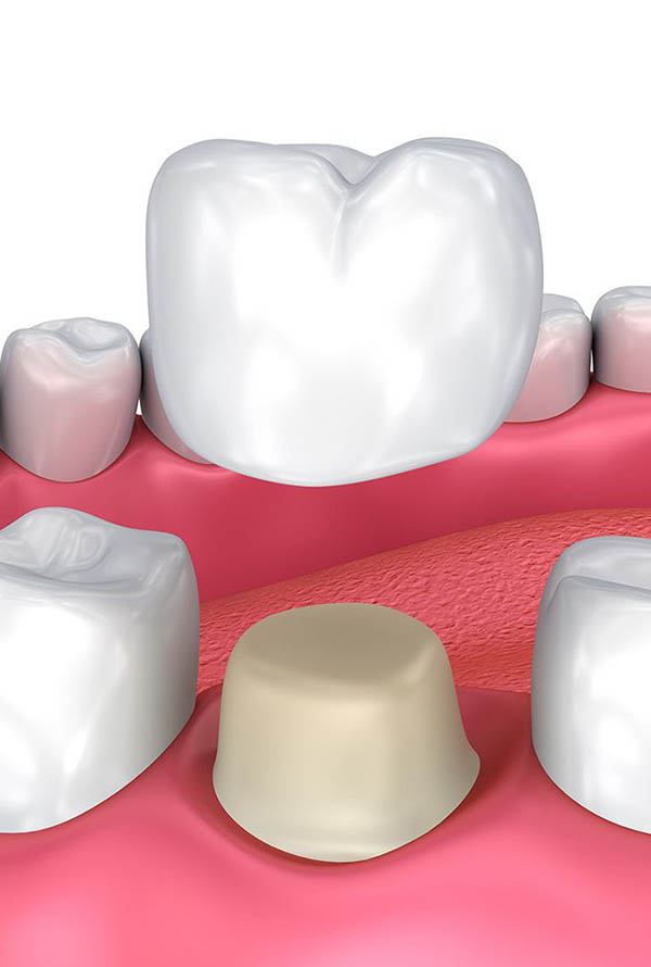 Dental Crowns Spring