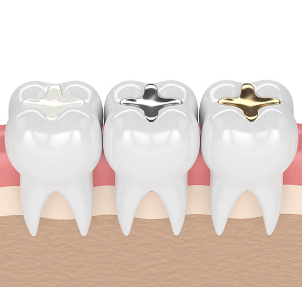Dental Fillings Spring
