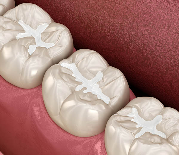 Dental Sealants in Spring, TX