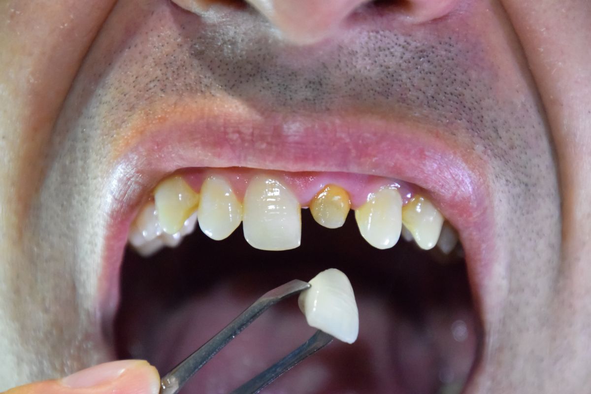 Dental Crowns Spring