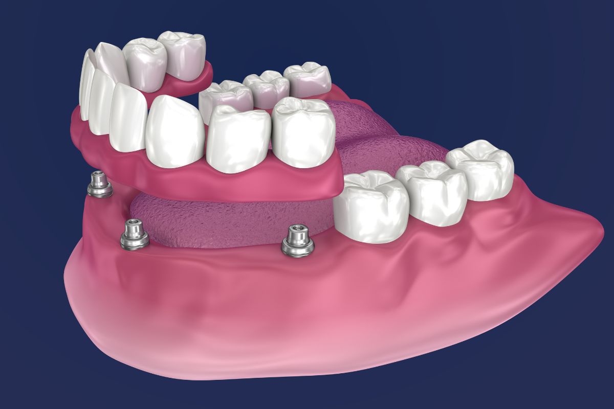 all on 4 dental implants spring