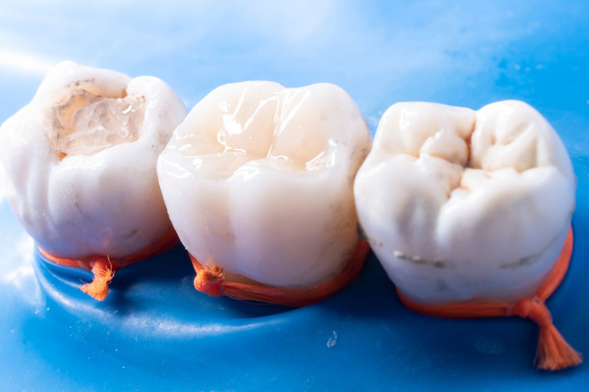 Dental Fillings Spring