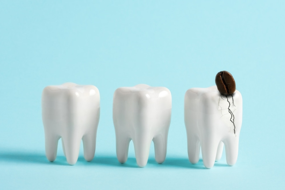Cracked Teeth Treatment