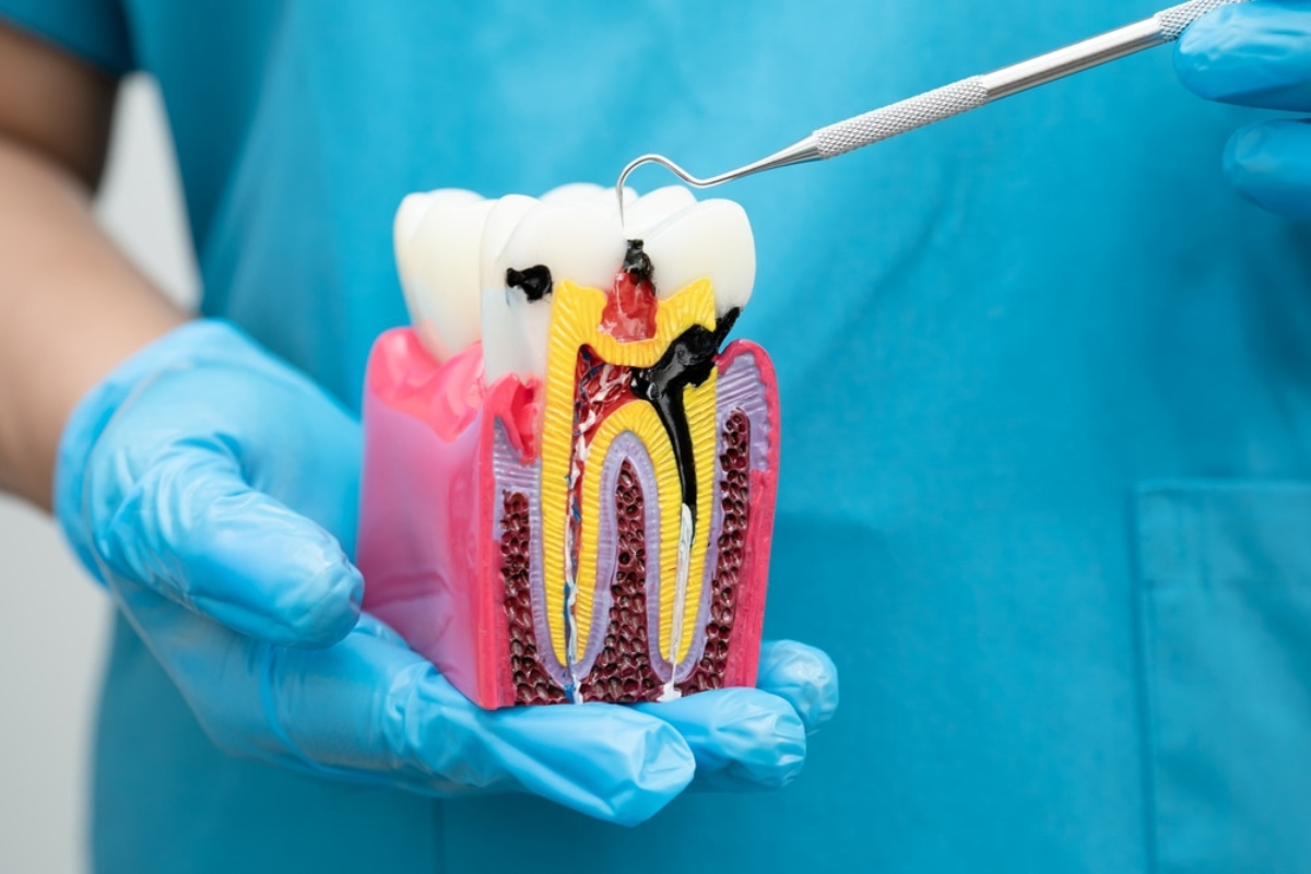 Root-Canal-Treatment