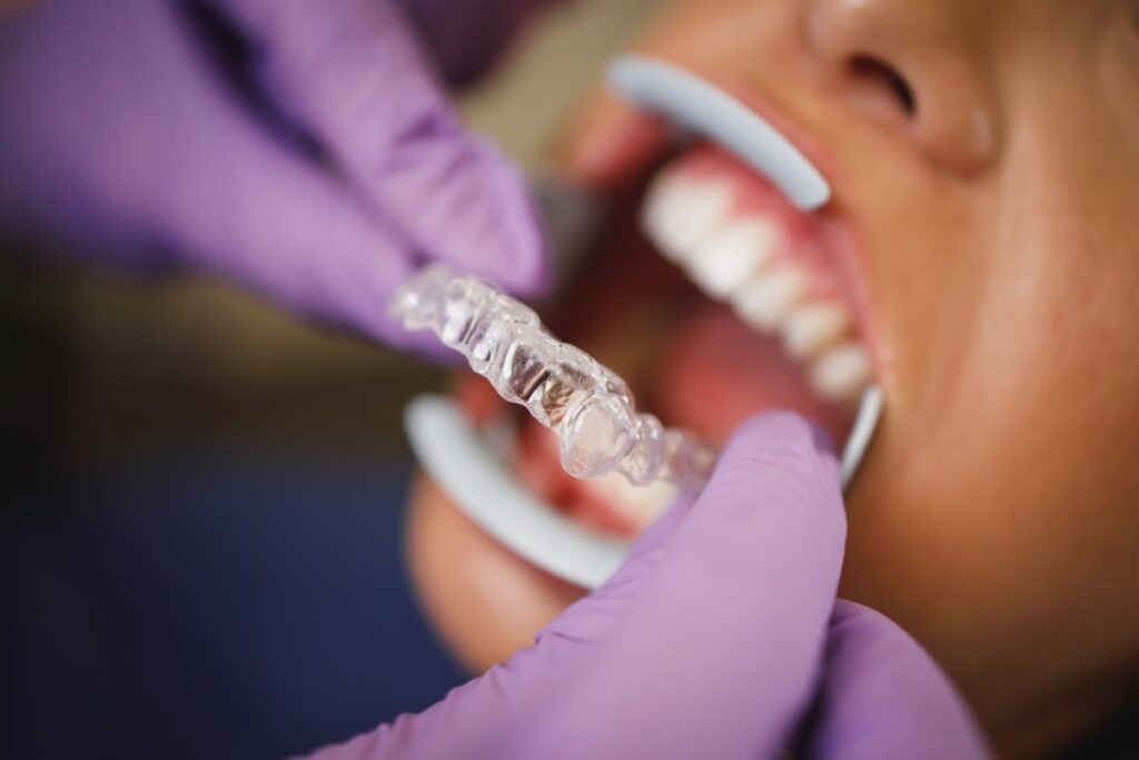 Tracking Issue Invisalin How to Fix Invisalign Tracking Issues Before They Get Worse