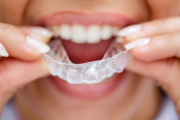 invisalign in Spring TX
