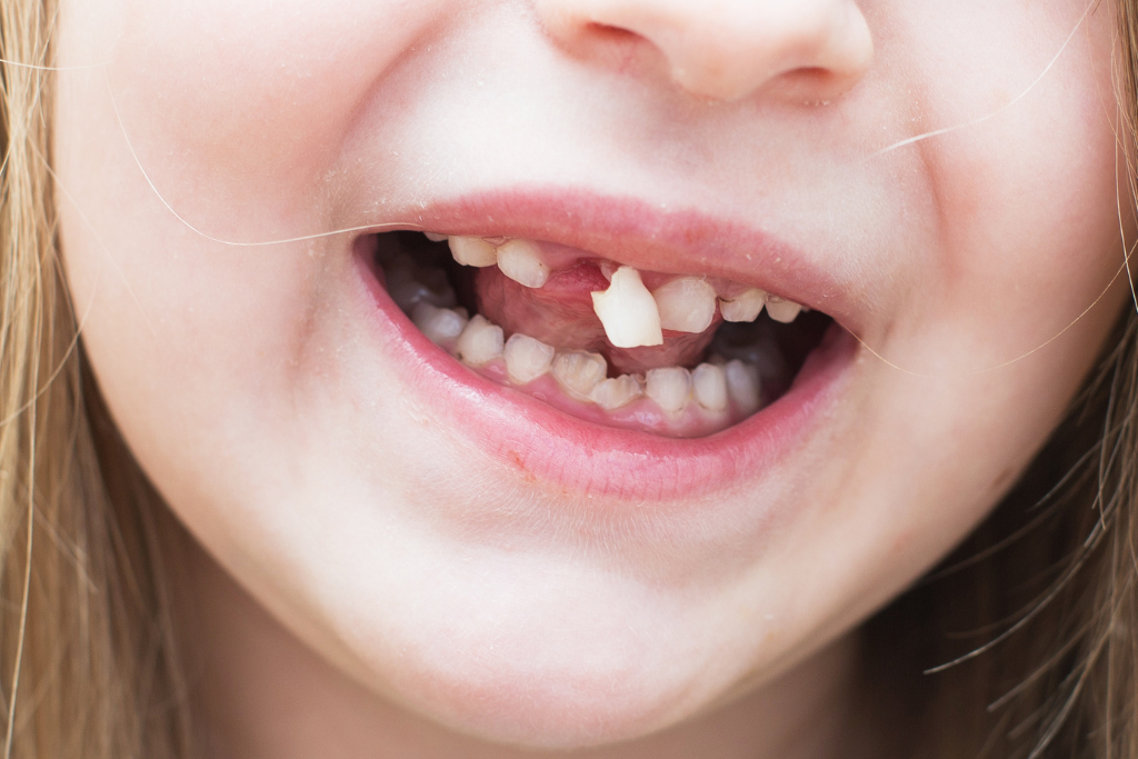 Patient receiving care from an emergency dentist in Spring, TX after a sports injury.