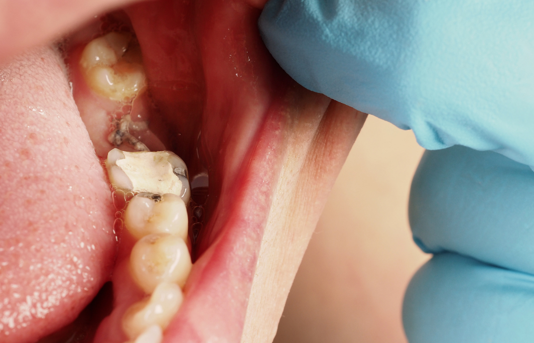 Emergency Dentist in Spring