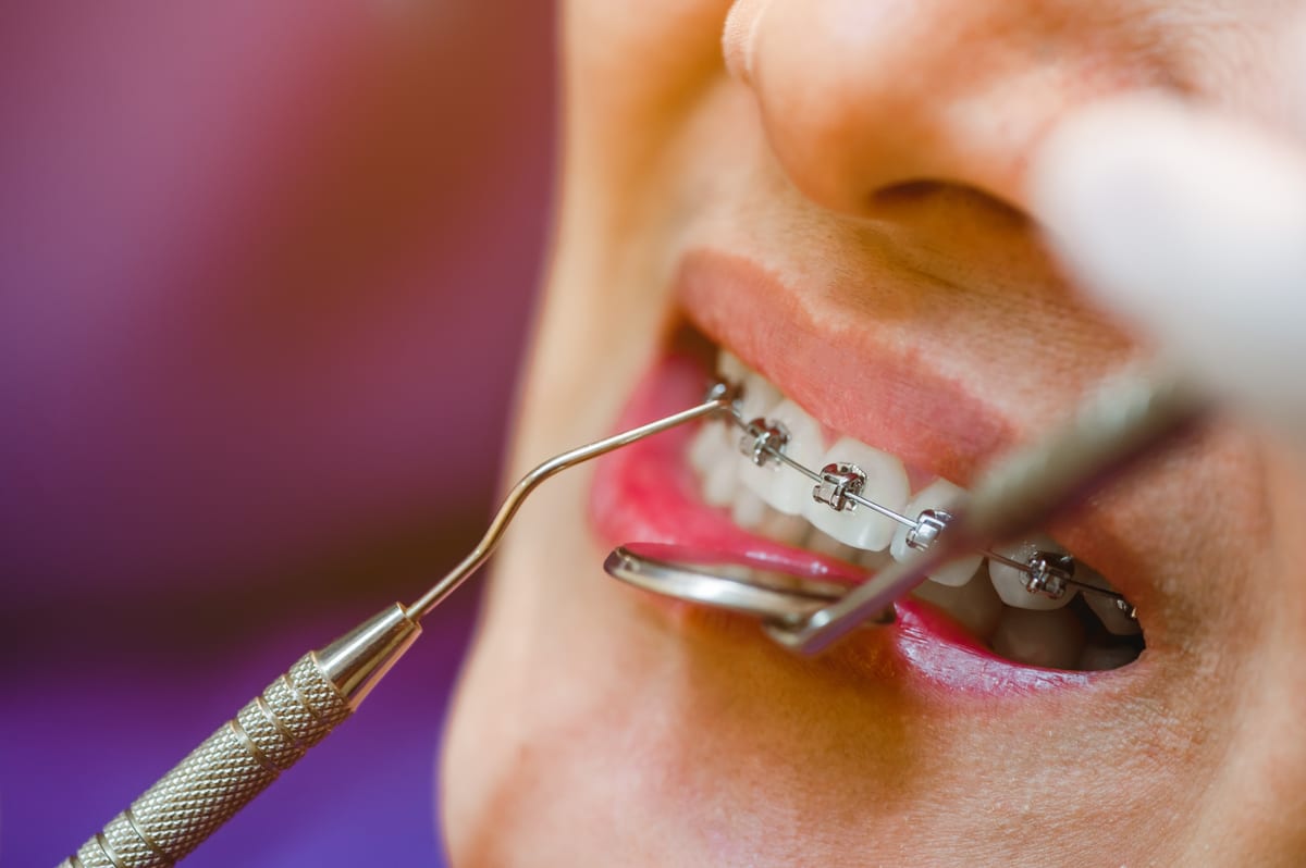 Dental Fillings in Spring